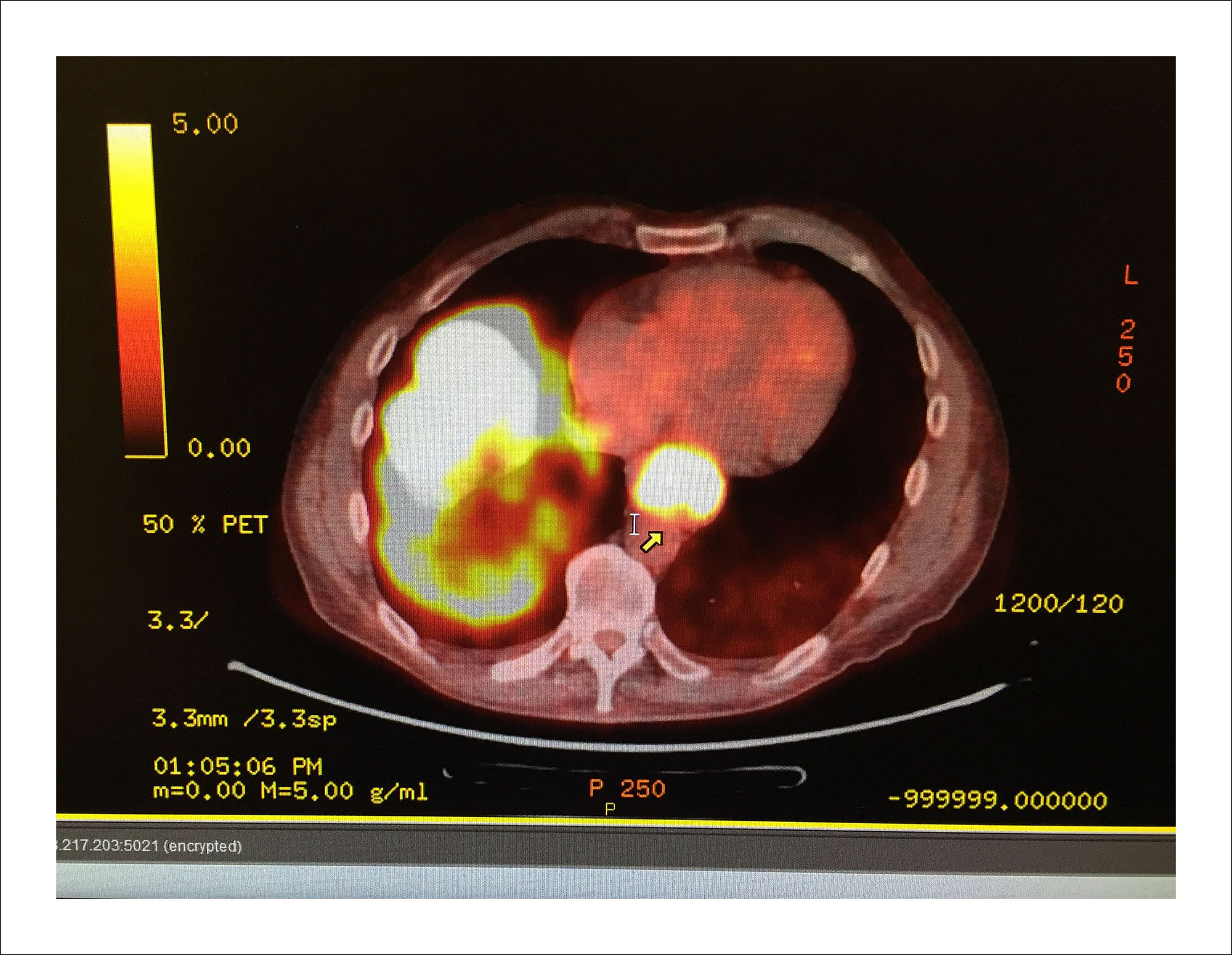 9/19/16 — Cancer cells grow faster and show more "heat" than normal. White hot is bad. The circle near the spinal cord is the tumor in my esophagus. The mass at left is in my liver.(Guy Reynolds/Staff Photographer)